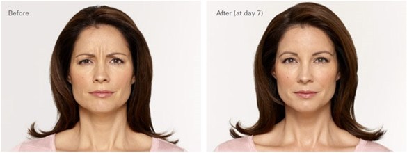 Botox fronsrimpel