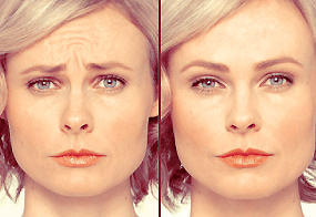Botox voor en nafoto