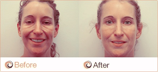 Juvederm-voor-en-na