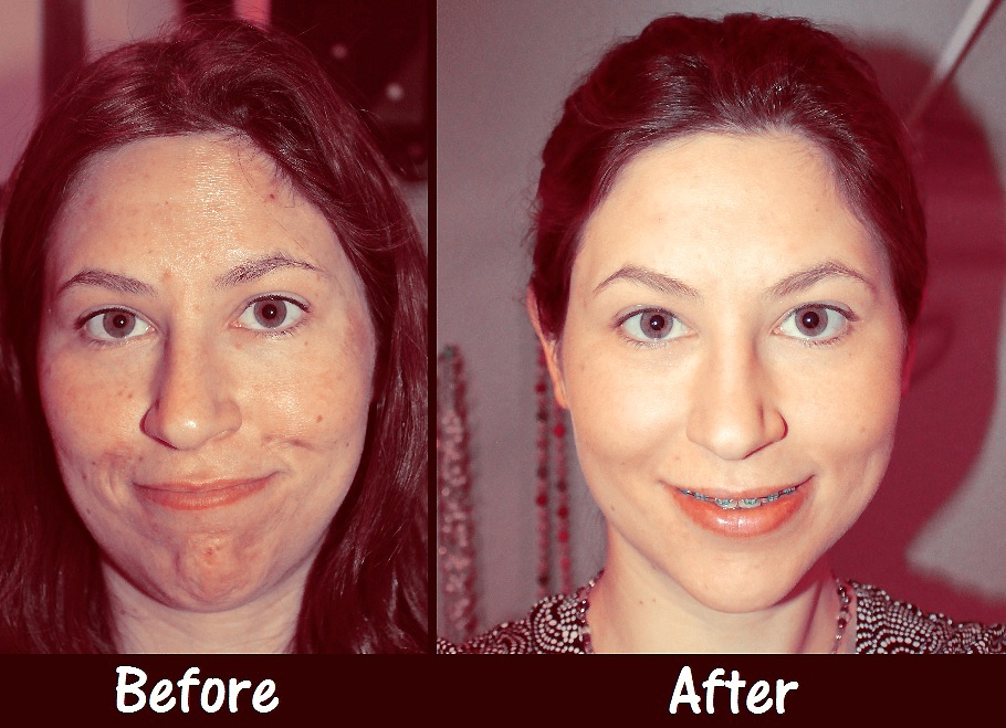Chemical-Peel-Before-and-After-2