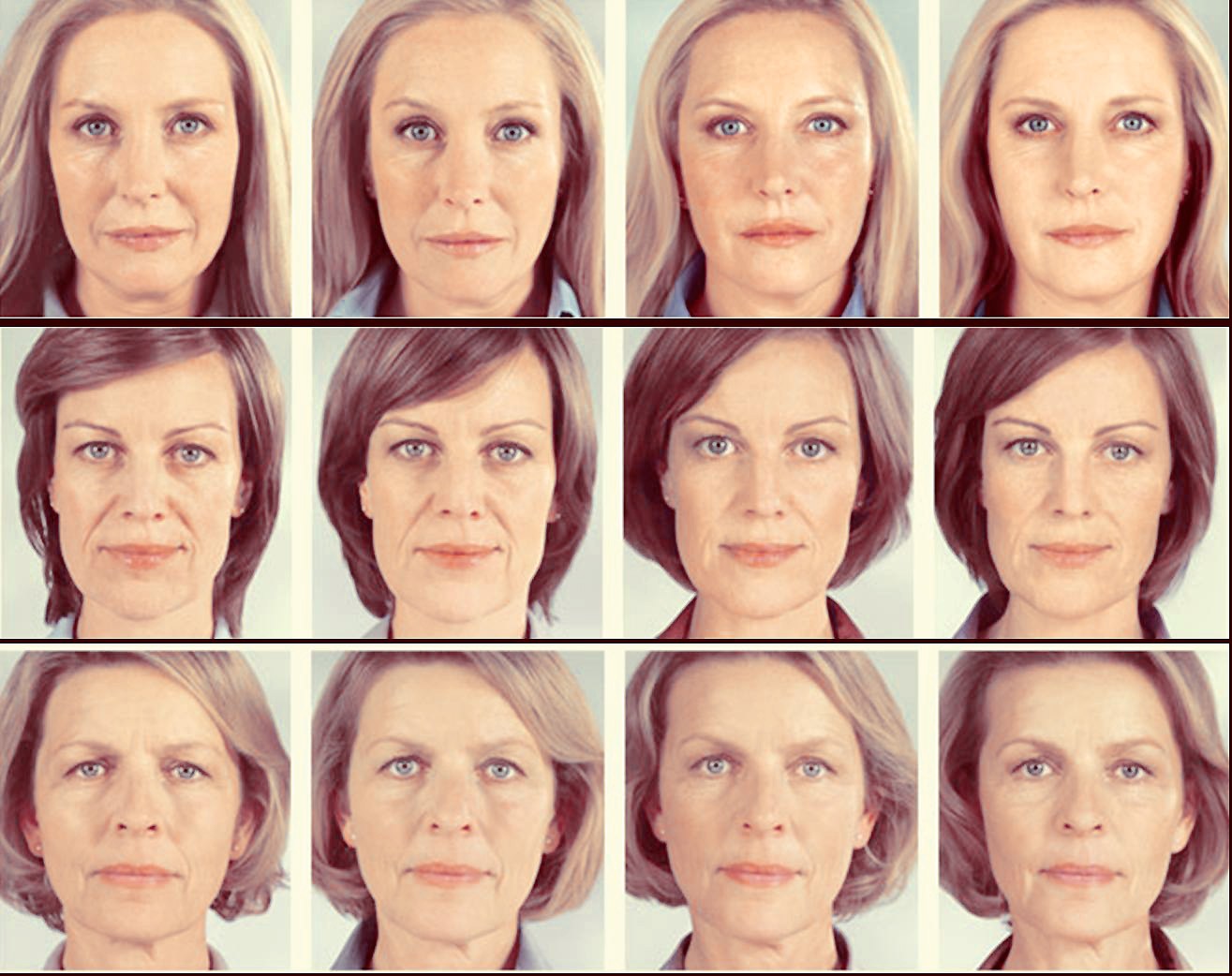 sculptra-voor-en-na