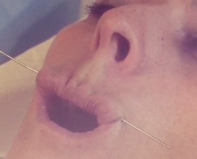 Boca_Happy-Lift_behandeling-1
