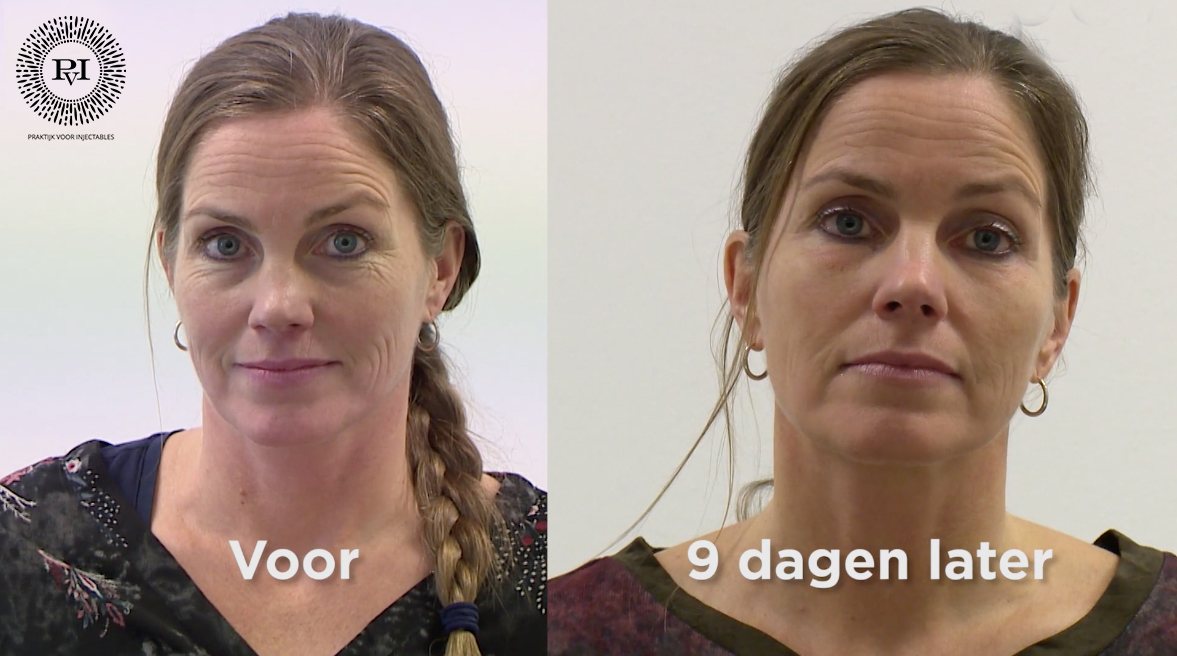 tanya-voor-en-na-plexr