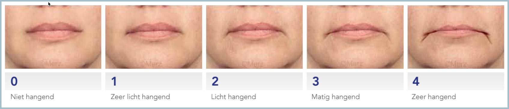 merzscales-hangende-mondhoeken