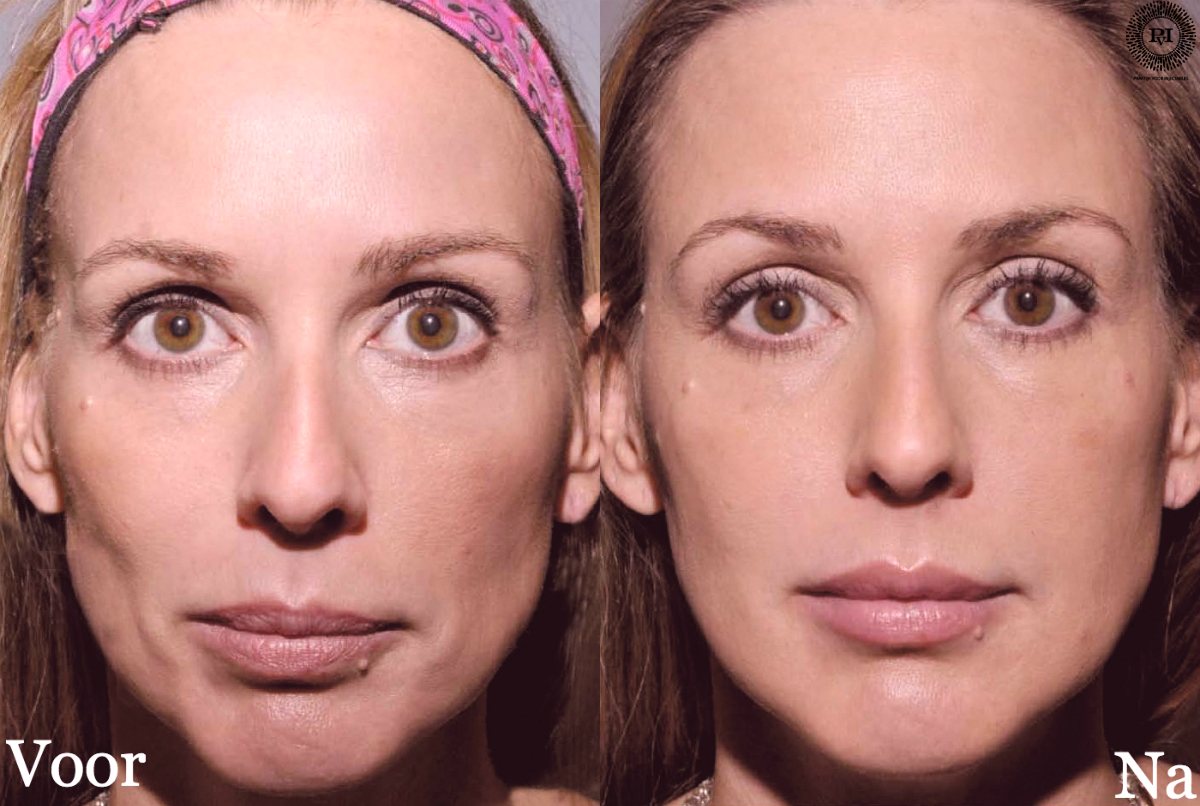 sculptra-voor-en-na