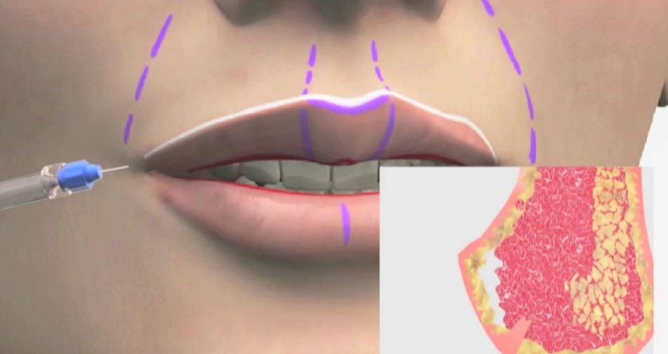 Behandeling van de lippen