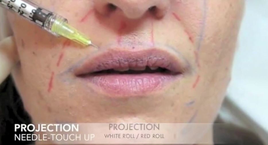 Behandeling van de lippen