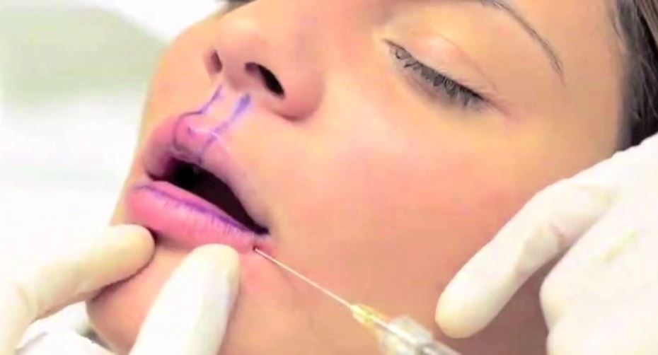 Behandeling van de lippen