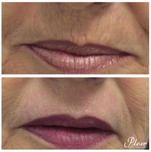 PLEXR nl lippen-1-1