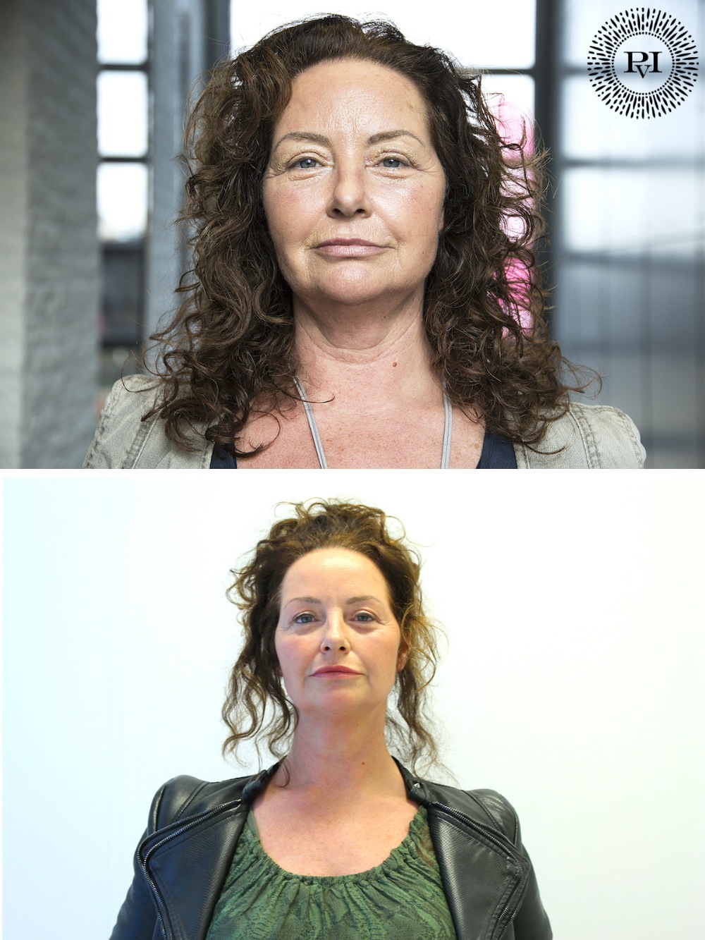 voor-na-hals-pvi