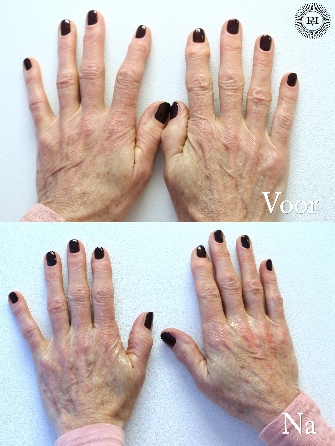 Voor en nafoto handen