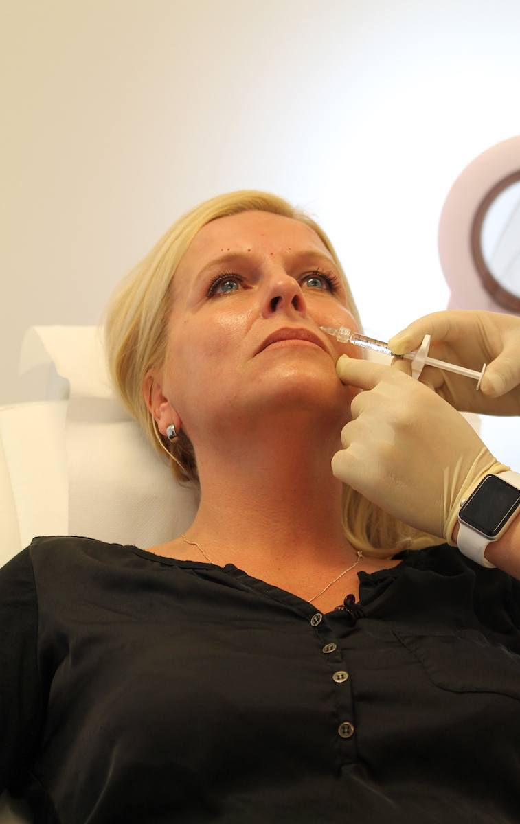 Sylvia neuslippenplooi behandeling fillers