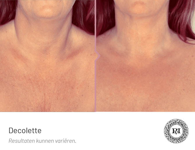 Voor-Na foto decollete