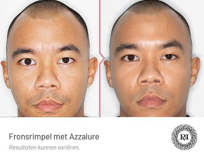 Voor en Na Fronsrimpel behandeling met botox