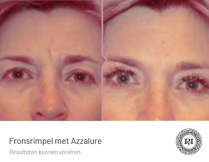 Voor en Na foto fronsrimpel met botox