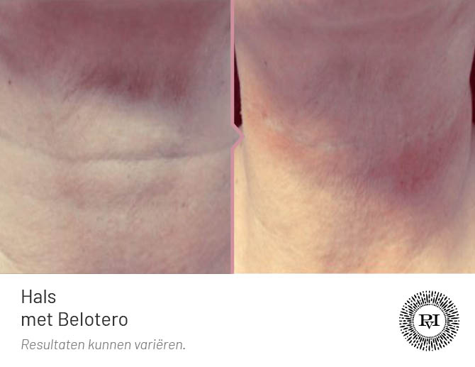 Voor en na foto Hals/nek met Belotero filler