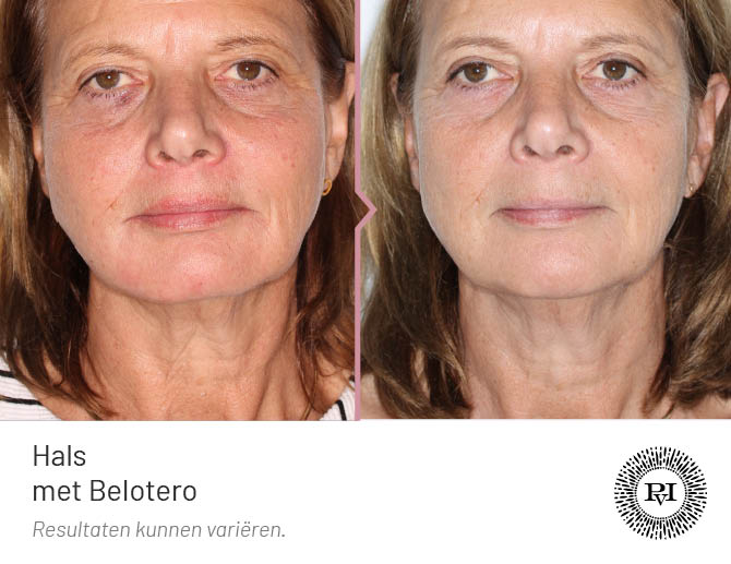 Voor en na foto hals/nek behandeling met Belotero filler
