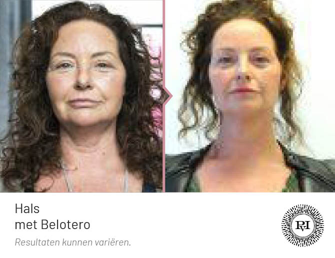 Voor-Na Hals met Belotero