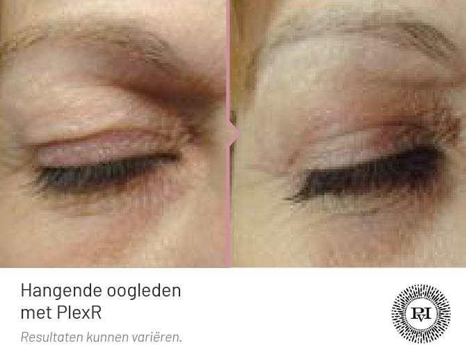Voor en na foto hangende oogleden Plexr