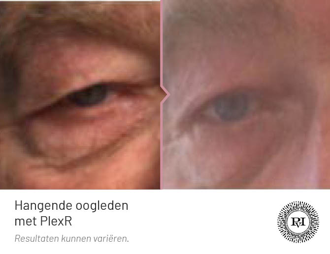 Voor en na foto hangende oogleden plexr behandeling