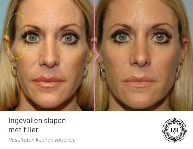Voor en na foto ingevallen slapen met filler