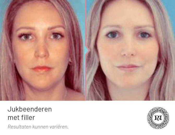 Voor en na foto jukbeenderen behandeling met filler