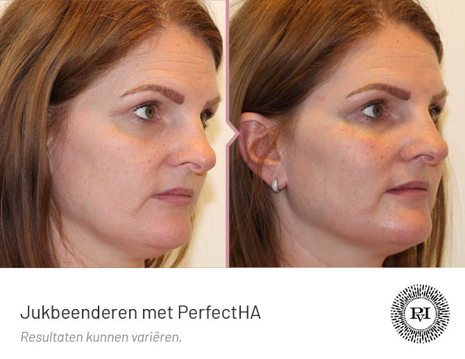 Voor en na foto Jukbeenderen behandeling met filler (Perfectha)