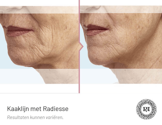 Voor en na foto Kaaklijn behandeling met Radiesse filler