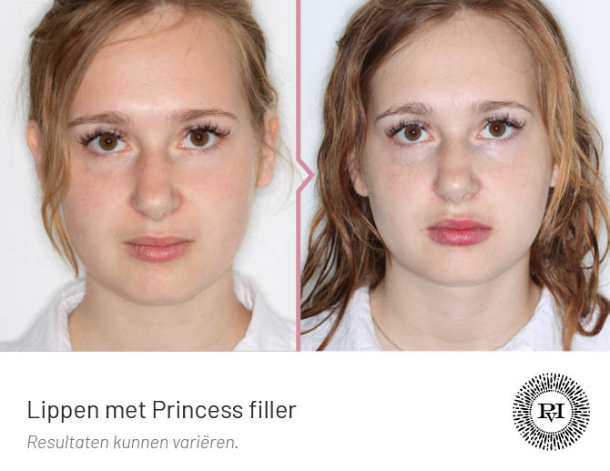 voor en na foto van de lippen behandeling met Saypha Princess filler