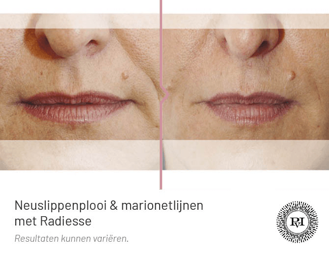 Voor en na foto  marionetlijnen behandeling met Radiesse filler