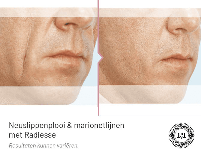 Voor en na foto marionetlijnen behandeling met Radiesse