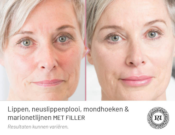 Voor en na foto wallen en traangoot behandeling met filler