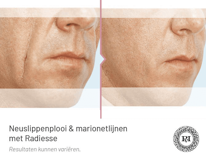 Voor en na foto neuslippenplooi en marionetlijnen behandeling met Radiesse filler