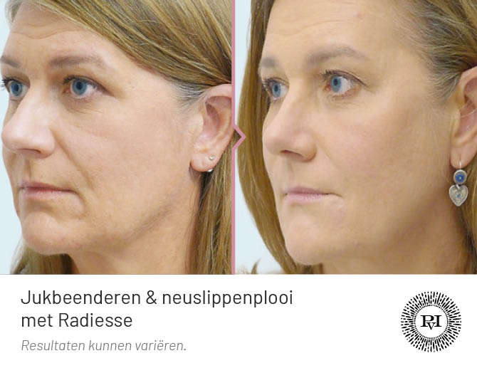 Voor en na neuslippenplooi en jukbeenderen behandeling met Radiesse filler