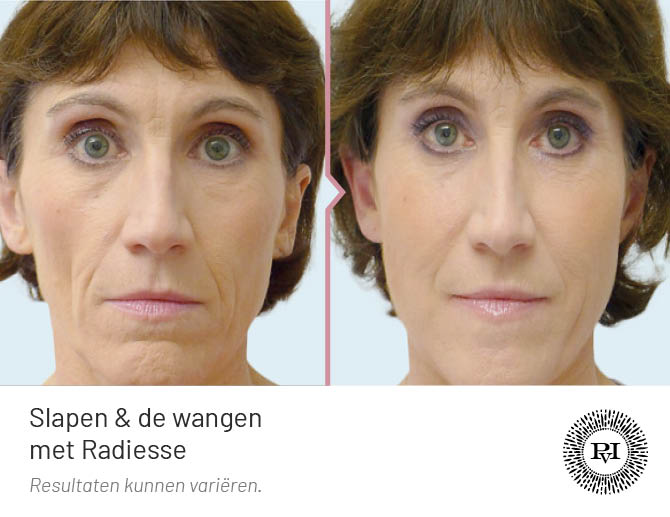 Voor en na Wallen, traangoot en ingevallen slapen met Radiesse filler