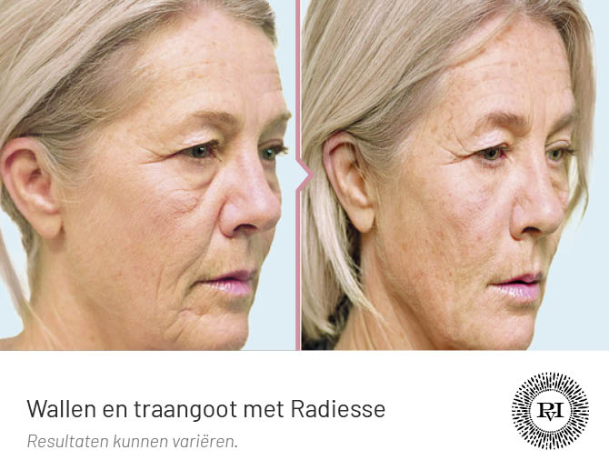 Voor en na foto Wallen en traangoot met Radiesse filler