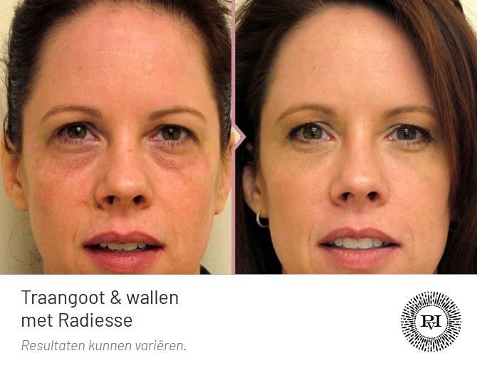 Voor en na Traangoot en wallen behandeling met Radiesse filler