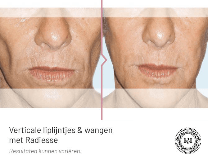 Voor en na foto wangen en verticale liplijntjes behandeling met Radiesse filler