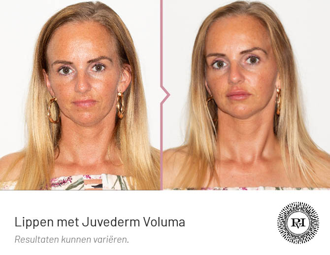 Voor en na Lippen behandeling  met Juvederm
