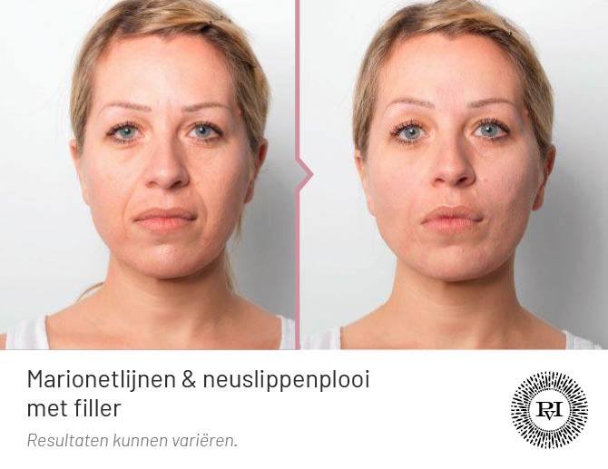 Voor en na marionetlijnen en neuslippenplooi met filler