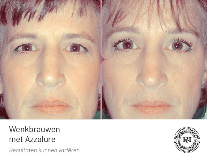 Voor en na foto wenkbrauwlift behandeling Azzalure