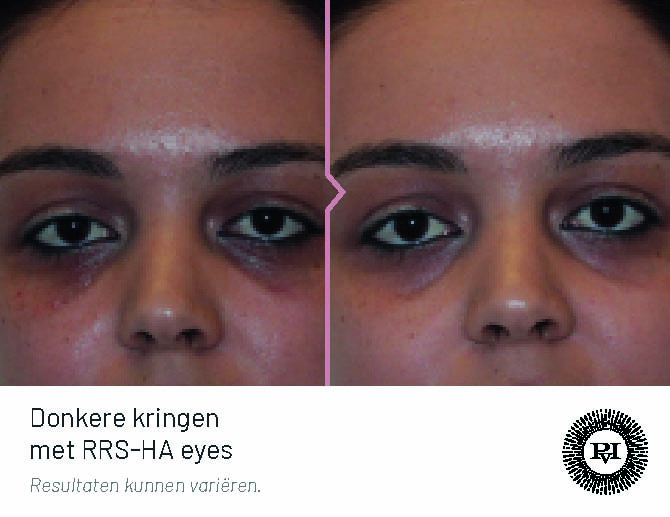 Voor-Na Donkere kringen met RRS-HA eyes
