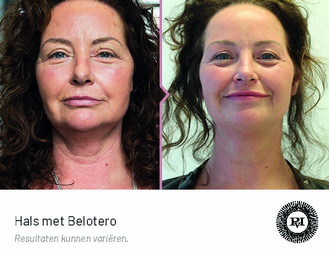 Voor-Na Hals met Belotero