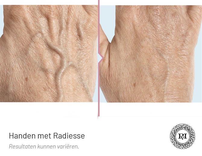 Voor-Na Radiesse handen