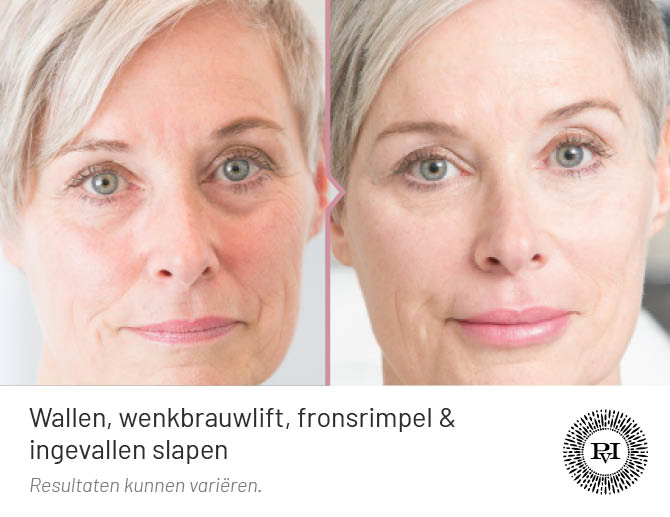 Voor-Na Wallen, wenkbrauwen, fronsrimpel, slapen