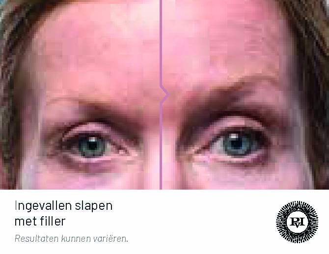 Voor-Na ingevallen slapen met filler2
