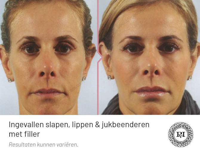 Voor-Na slapen, jukbeenderen en lippen