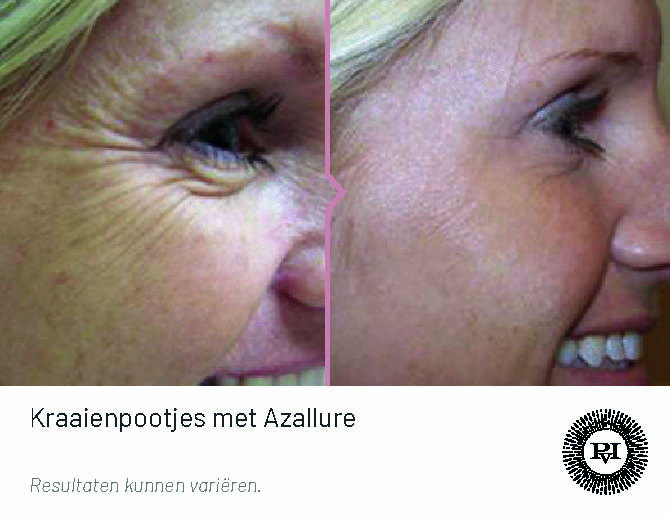 Kraaienpootjes behandeling