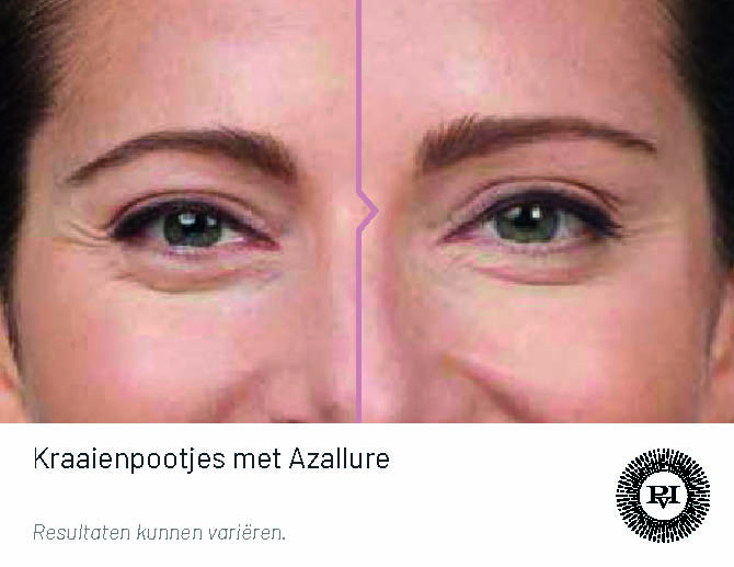 Kraaienpootjes behandeling