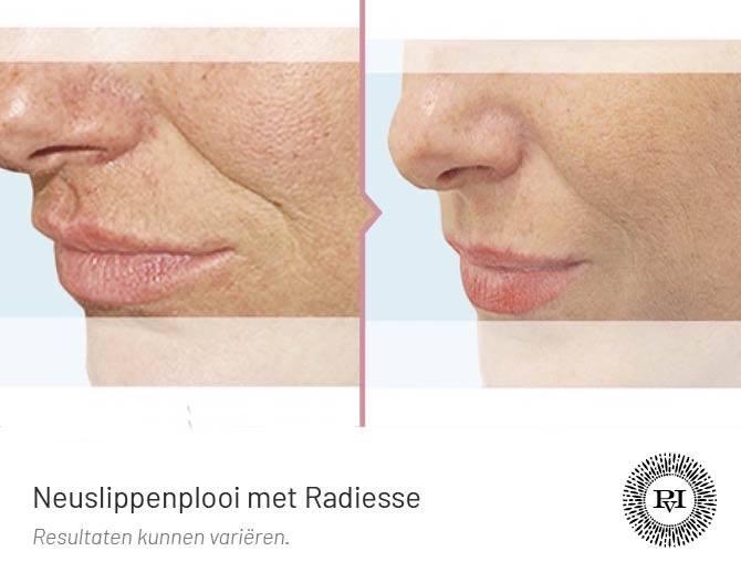 Voor-Na Radiesse neuslippenplooi